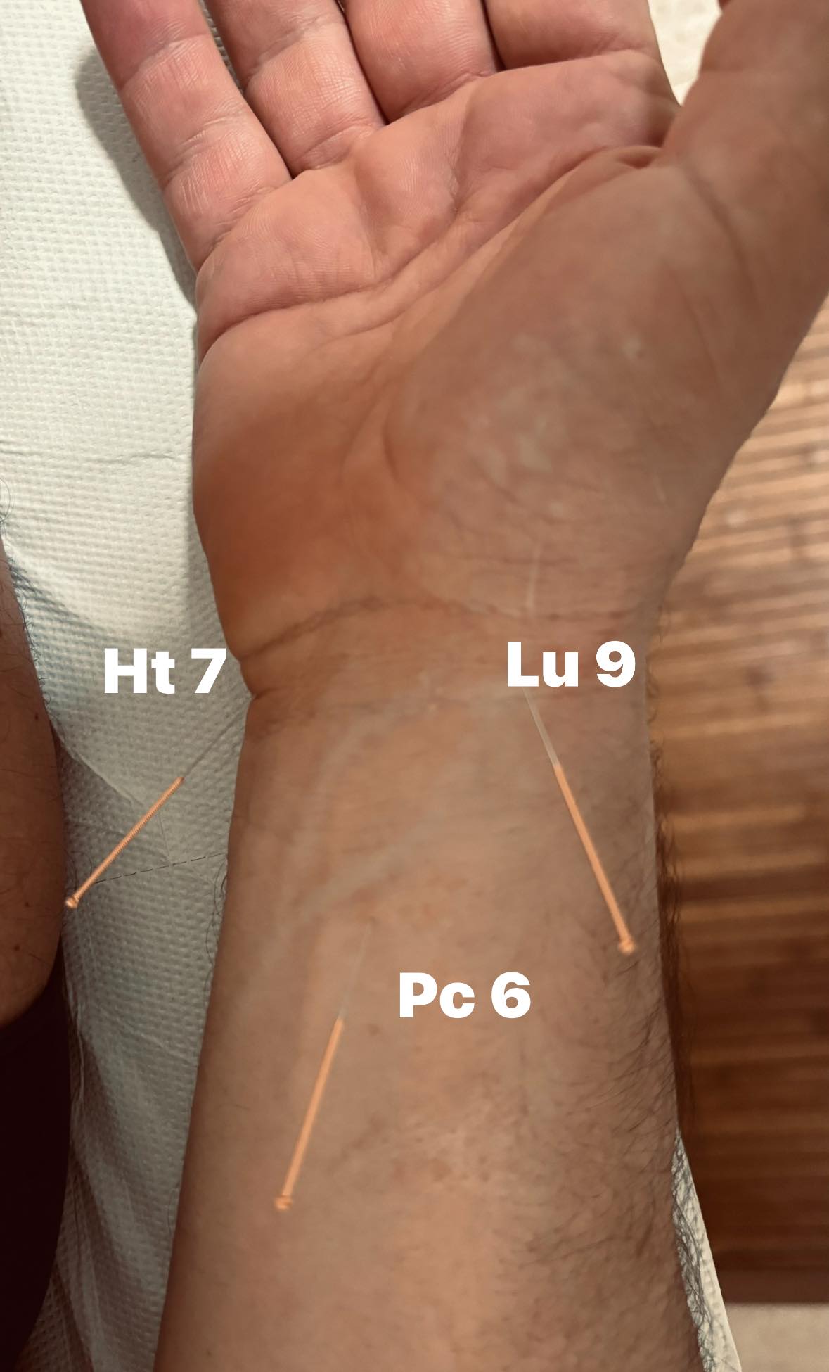 Agopuntura per infiammazione articolare a Villa San Giovanni